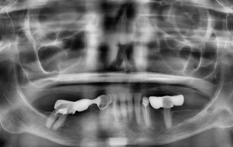 Снимок Ситуация с зубами до имплантации