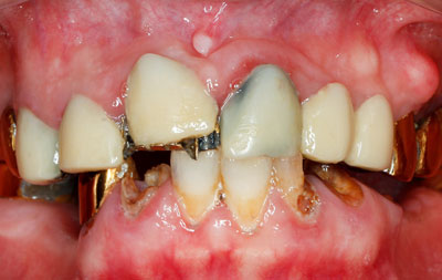 Разрушенные зубы до имплантации