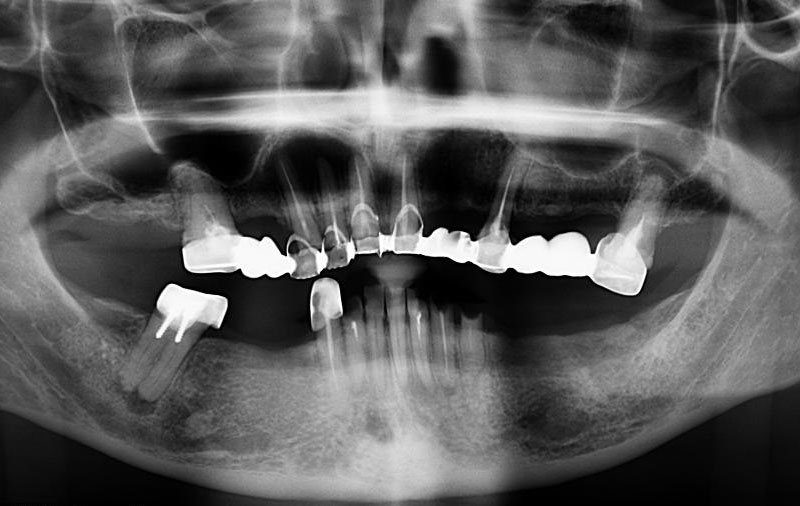 Снимок Разрушенные зубы до имплантации