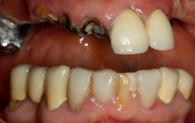 До имплантации зубов при атрофии костной ткани