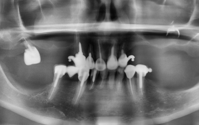 Снимок До имплантации зубов при атрофии костной ткани