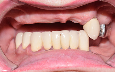 Частичное отсутствие зубов на нижней челюсти