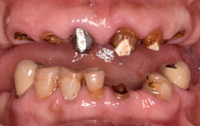 фото разрушенных зубов