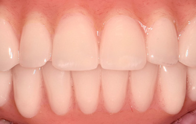 восстановленные зубы методом All-on-4