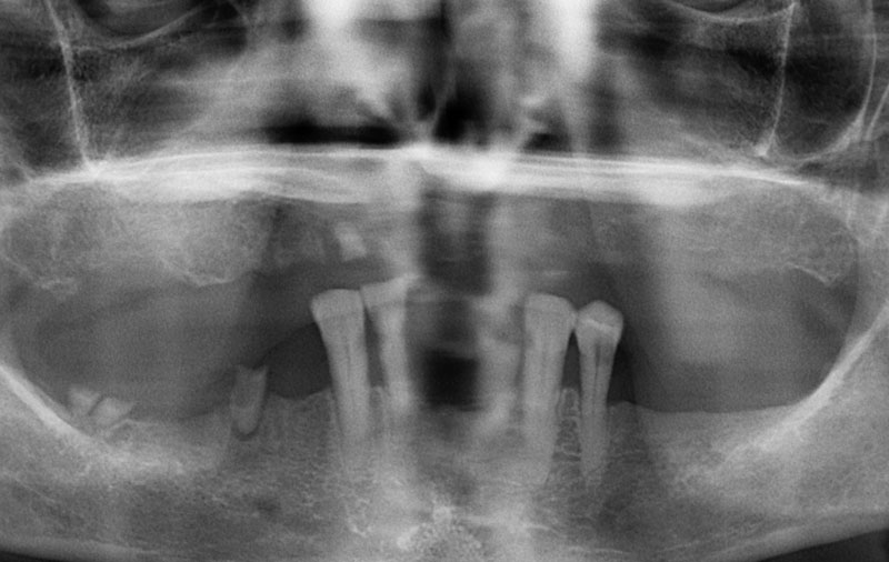 Снимок Отсутствие зубов на верхней челюсти