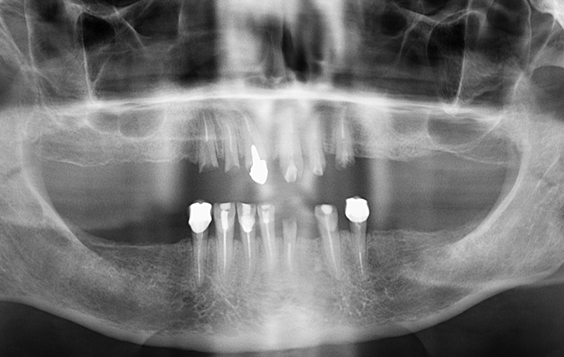 Снимок фото разрушенных зубов