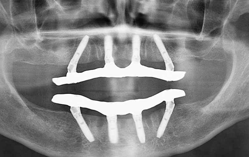 Снимок восстановленные зубы методом All-on-4