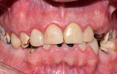 разрушенные зубы