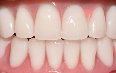 Восстановление зубов при помощи протокола имплантации All-on-6
