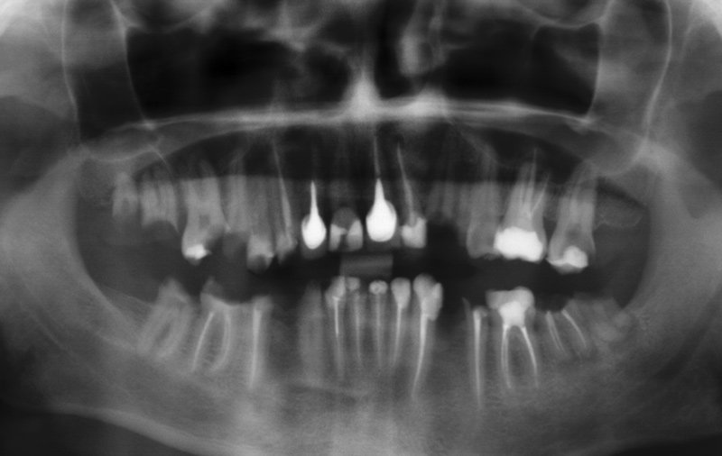 Снимок разрушенные зубы