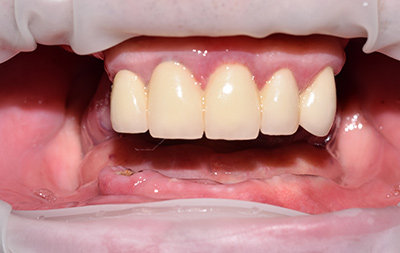 Полное отсутствие зубов на верхней челюсти