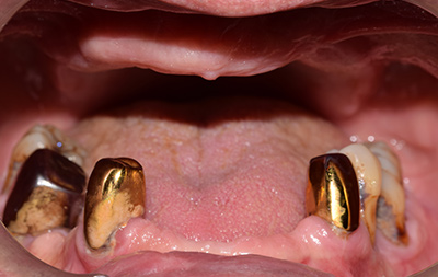 Отсутствие зубов на верхней и нижней челюсти