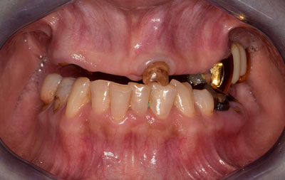 Фото зубов до имплантации all-on-4