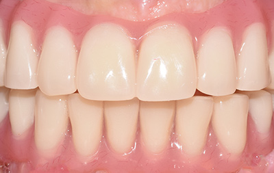 проведена базальная имплантация зубов двух челюстей