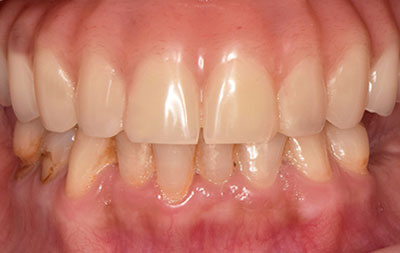 Фото зубов после имплантации all-on-4 на верхней челюсти