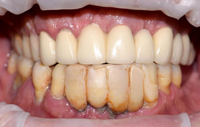 Фото зубов до лечения