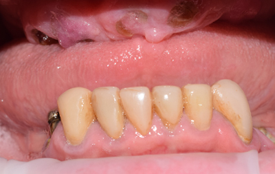 Разрушенные зубы до лечения