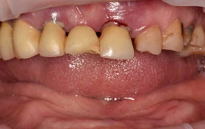 Фото проблем с зубами до имплантации зубов