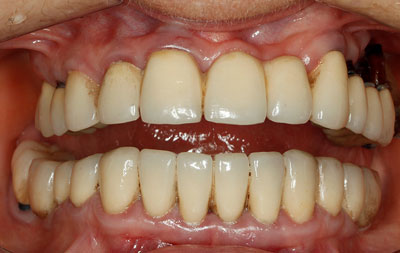Фото до имплантации зубов