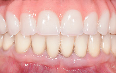 Фото после имплантации зубов на верхней челюсти