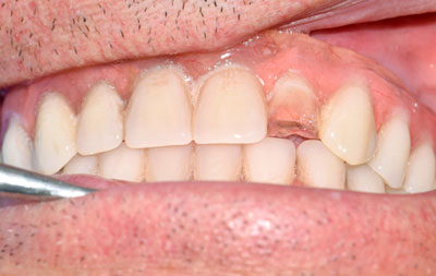 Скол зуба на протезе с опорой на импланты