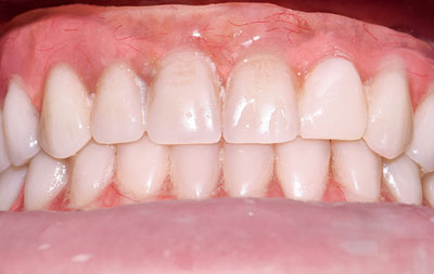 Проведено восстановление сколотого зуба