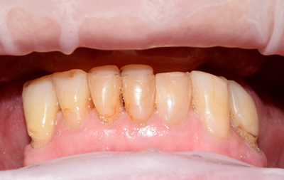 Полное отсутствие зубов на верхней челюсти с острой атрофией костной ткани