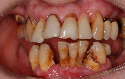 Фото состояния зубов до комплексной имплантации зубов