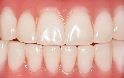 восстановление всех зубов по протоколу базальной имплантации