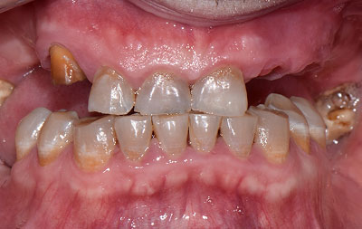 Фото до комплексной имплантации и установки виниров на зубы