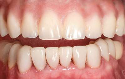 Фото после имплантации зубов All-on-4 и установки виниров