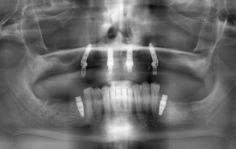 Снимок Фото после имплантации зубов All-on-4 и установки виниров
