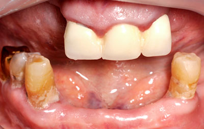 Фото поврежденных зубов на обеих челюстях