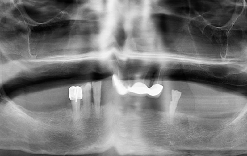 Снимок Фото поврежденных зубов на обеих челюстях