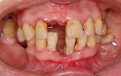 Фото зубов пациента до проведения имплантации
