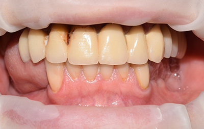 Частичное отсутствие зубов на нижней челюсти