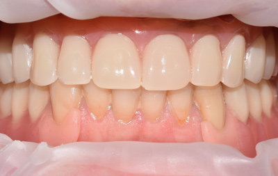 Проведена базальная имплантация зубов на верхней челюсти