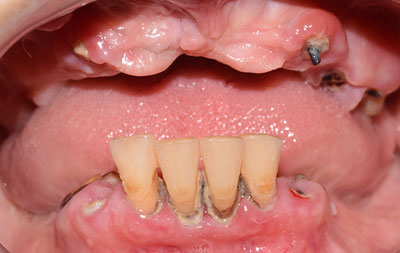 Фото проблемы с зубами у пациента до лечения