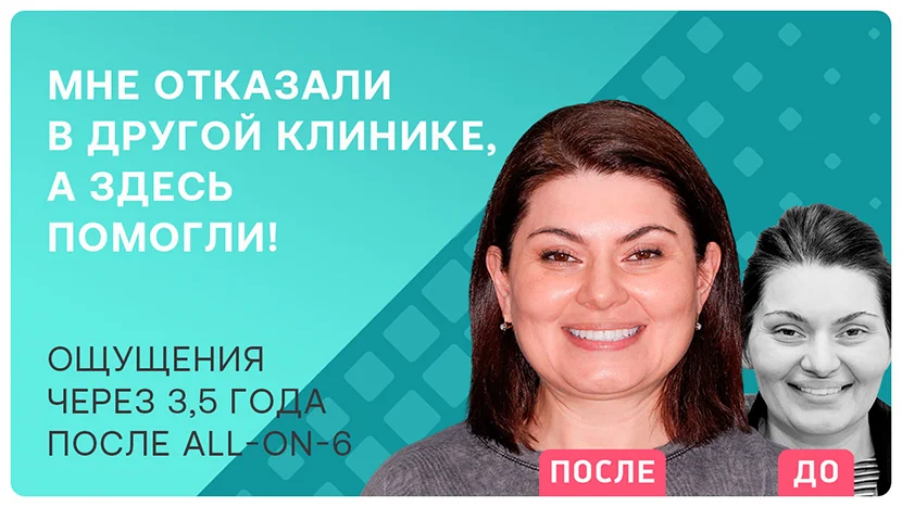 Видео-отзыв об имплантации all-on-6 через 3,5 года