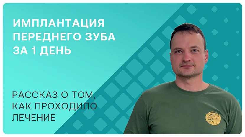 Видео-отзыв после имплантации переднего зуба за один день