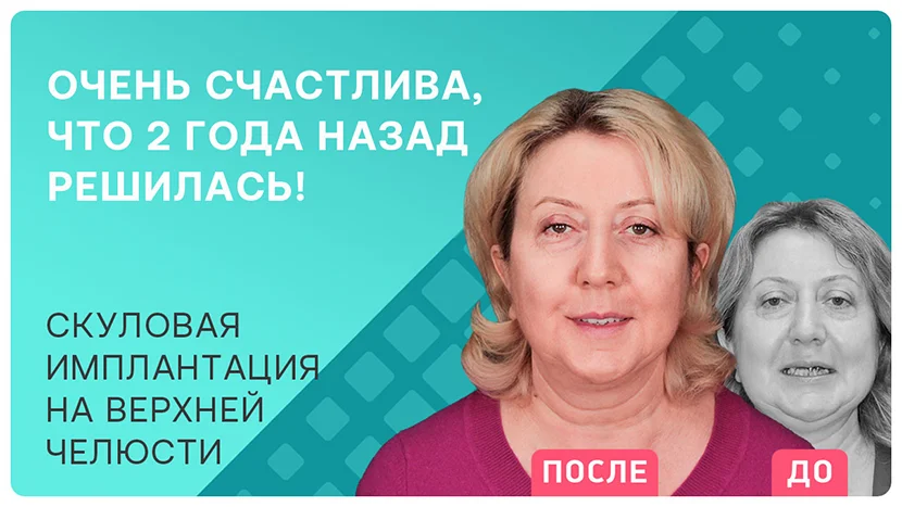 Видео-отзыв через 2 года после скуловой имплантации зубов на верхней челюсти