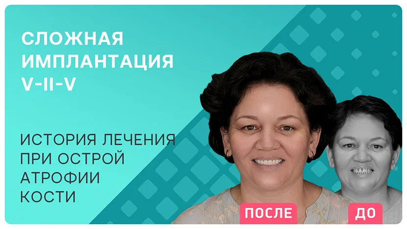 Видео-отзыв после сложной имплантации V-II-V all-on-6 на верхней челюсти