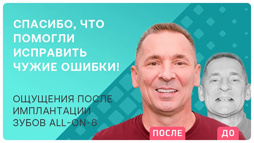 Видео отзыв про имплантацию зубов All-on-6 за 3 дня