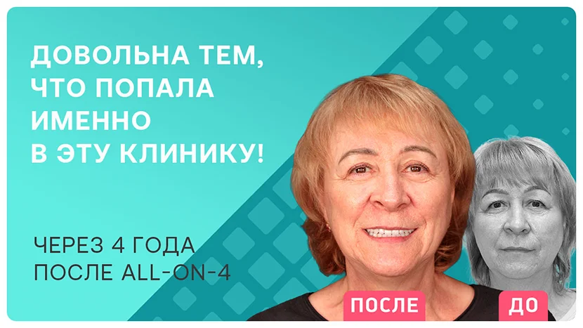 Видео-отзыв через 4 года после имплантации зубов all-on-4