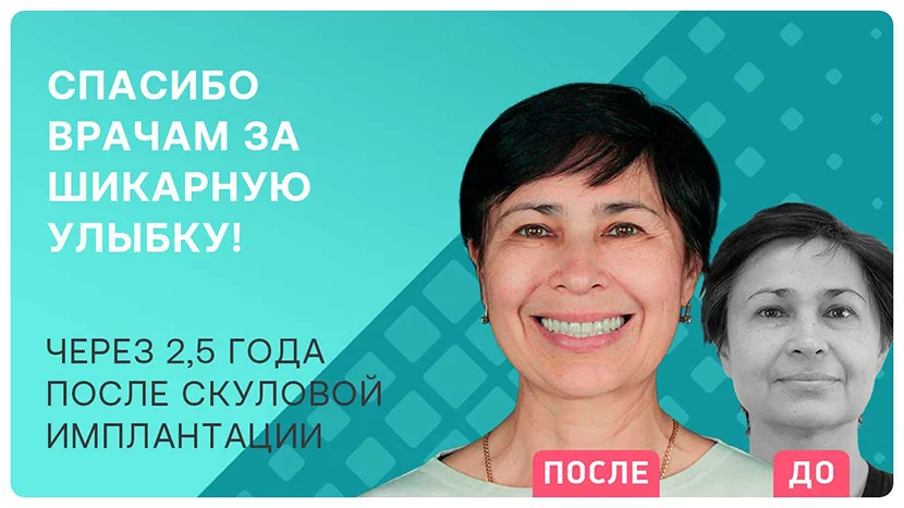 Видео отзыв после имплантации всех зубов ALL-ON-4 Nobel Zygoma
