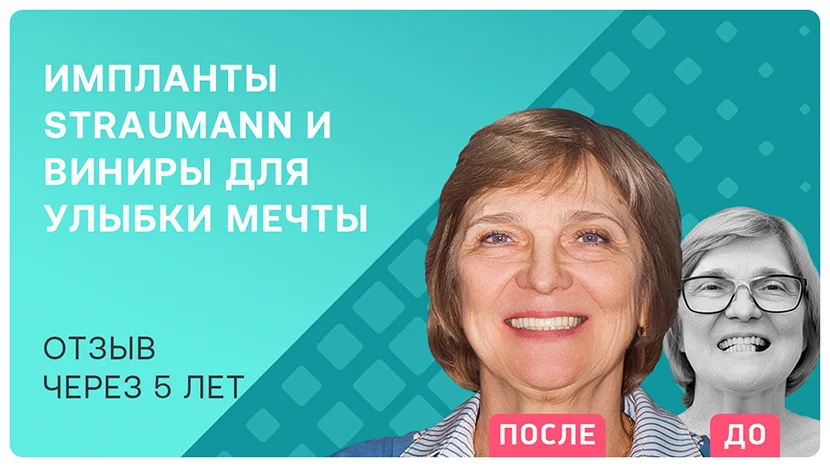 Видео-отзыв через 5 лет после имплантации зуба и установки виниров