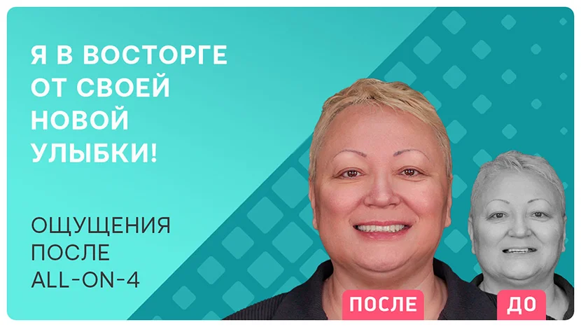 Видео-отзыв про имплантацию all-on-4