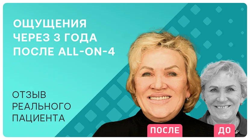 Видео-отзыв через 3 года после имплантации all-on-4