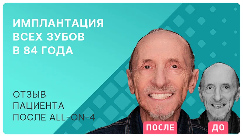 Видео-отзыв после имплантации всех зубов в пожилом возрасте