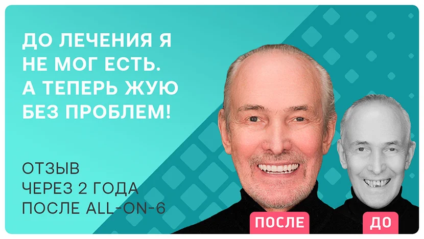 Видео-отзыв о скуловой имплантации зубов all-on-6